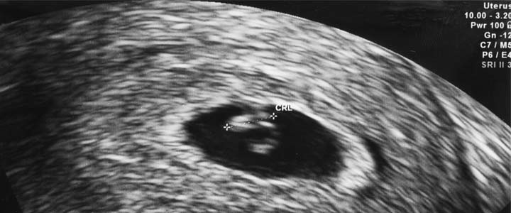 6-weken-echo-v95 6 weken echo